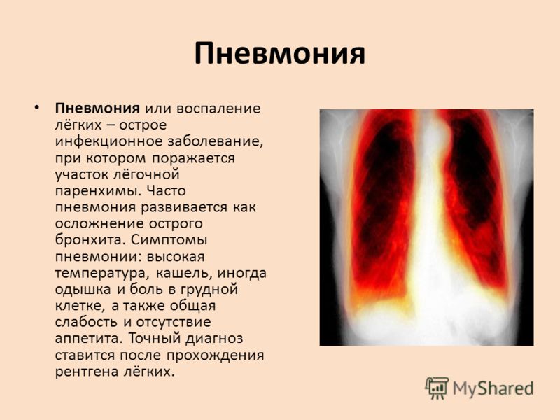 Пневмония Пневмония или воспаление лёгких – острое инфекционное заболевание, при котором поражается участок лёгочной паренхимы. Часто пневмония развив