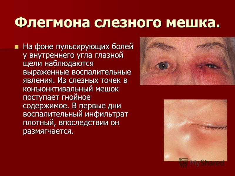 Восстановления зрения методом жданова видео