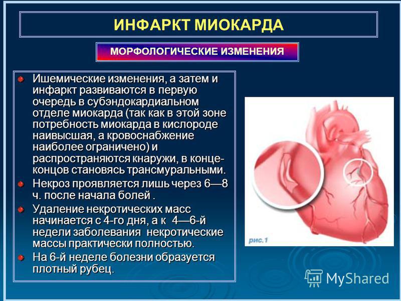 Лекция: Инфаркт миокарда. Скачать бесплатно и без регистрации Лекция: Инфаркт миокарда. Скачать бесплатно и без регистрации