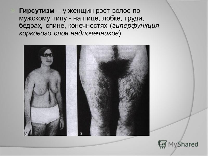 У женщины повышенный мужской гормон как лечить У женщины повышенный мужской гормон как лечить