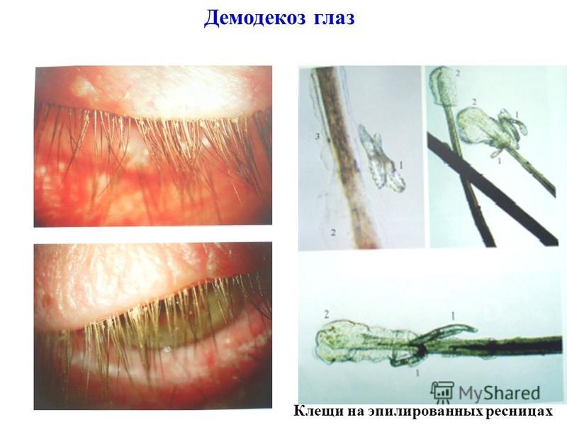 Не могу вылечить демодекс на ресницах Не могу вылечить демодекс на ресницах