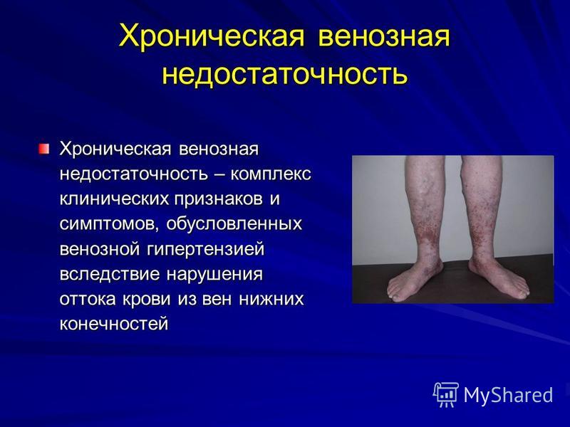 Реферат по теме Функциональные пробы состояния клапанов вен нижних конечностей Реферат по теме Функциональные пробы состояния клапанов вен нижних конечностей