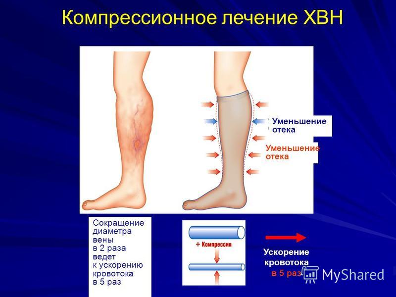 препараты для лечения венозной недостаточности нижних конечностей это специальная нательная