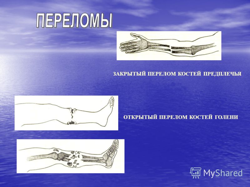 Тепловые ожоги кожи Тепловые ожоги кожи