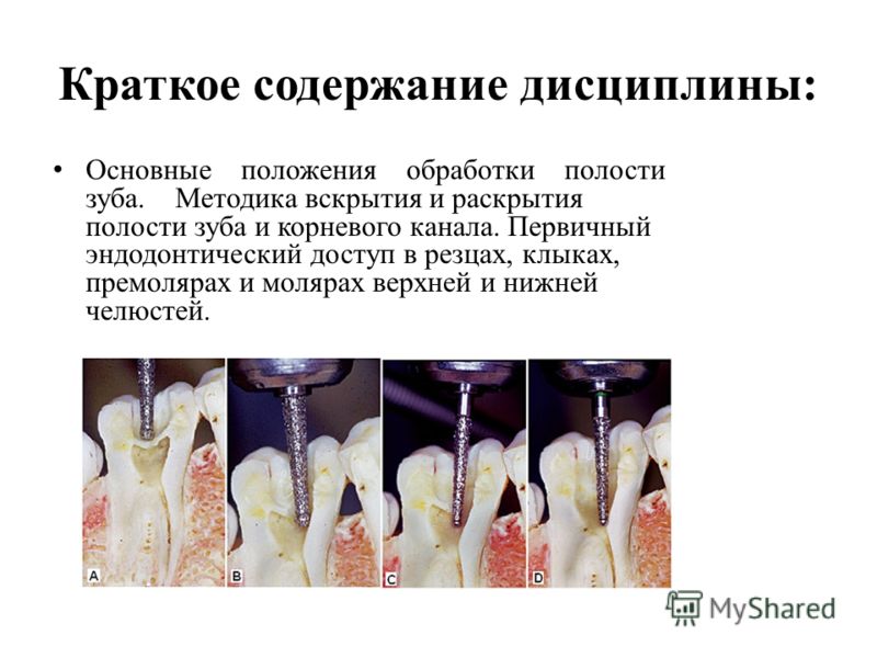 Краткое содержание дисциплины: Основные положения обработки полости зуба. Методика вскрытия и раскрытия полости зуба и корневого канала. Первичный энд