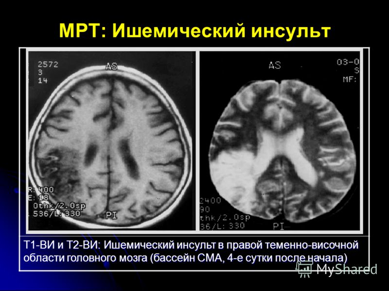 реабилитация после липосакции реабилитация после липосакции