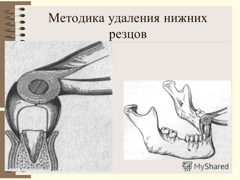 Лунки после удаления зубов у детей Лунки после удаления зубов у детей