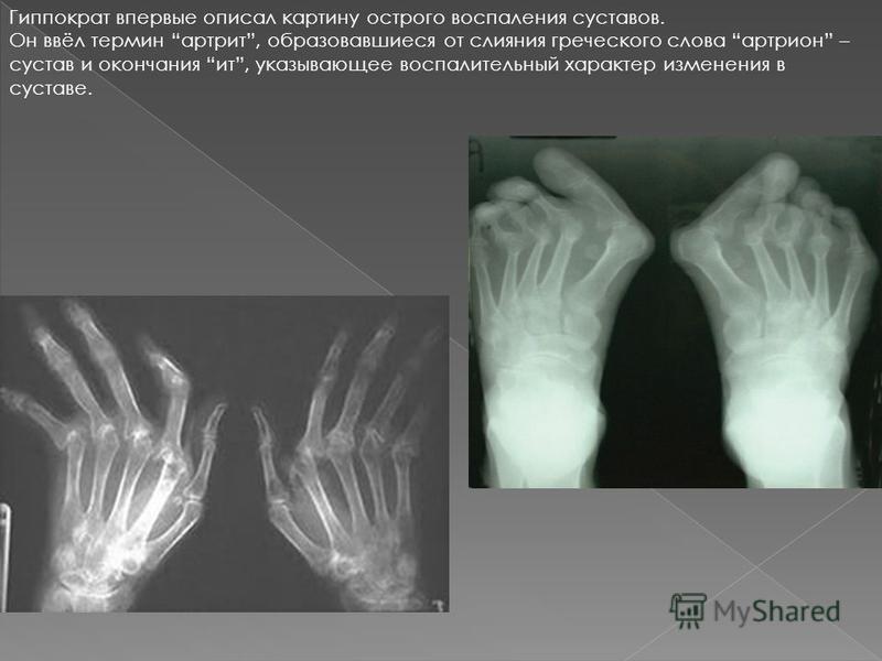 Отложение солей на шее: лечение, упражнения, диета - Мюсли. ру Остеохондроз - Лечебные упражнения при