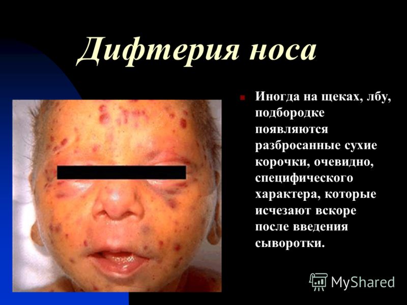 Шелушение кожи вокруг носа и на лбу Шелушение кожи вокруг носа и на лбу