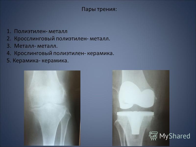 Пары трения сустав Пары трения сустав