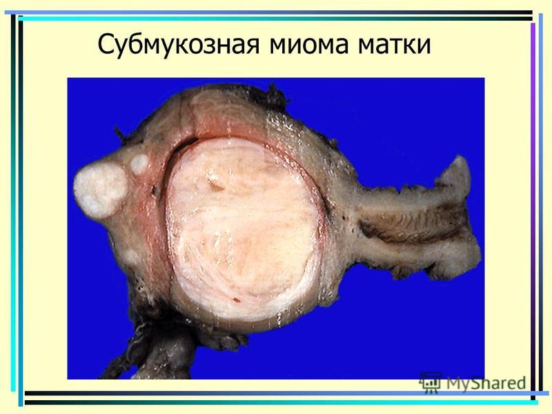 Миома матки и ее осложнения. Показания к оперативному лечению. Виды операций