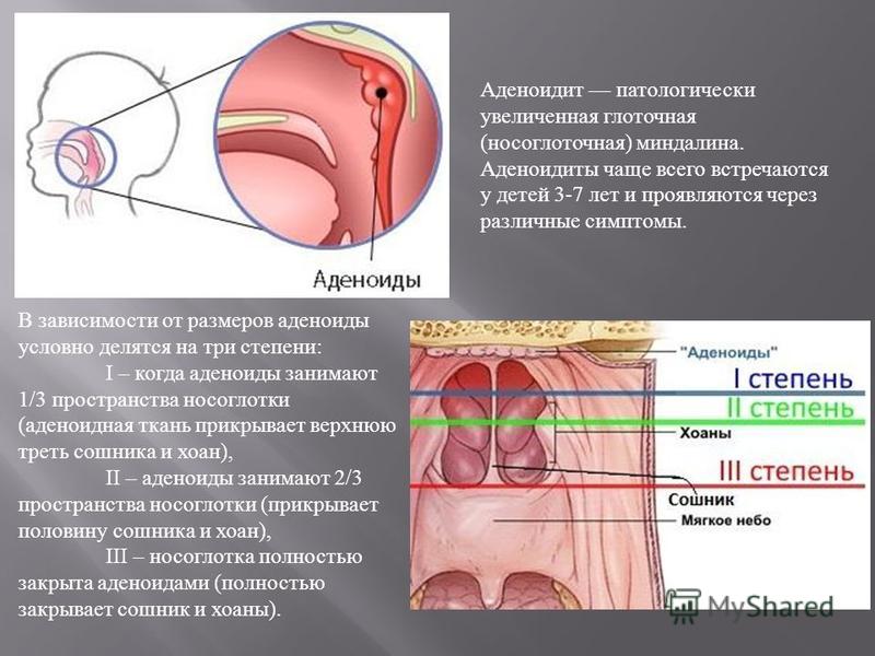 Лечение аденоидов у ребенка схема Лечение аденоидов у ребенка схема