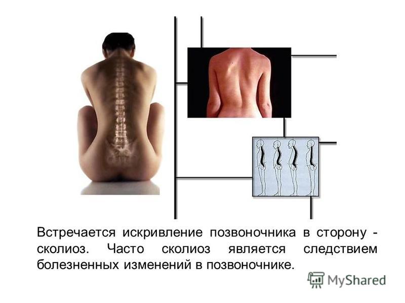 Как лечить искривление позвоночника в домашних Как лечить искривление позвоночника в домашних