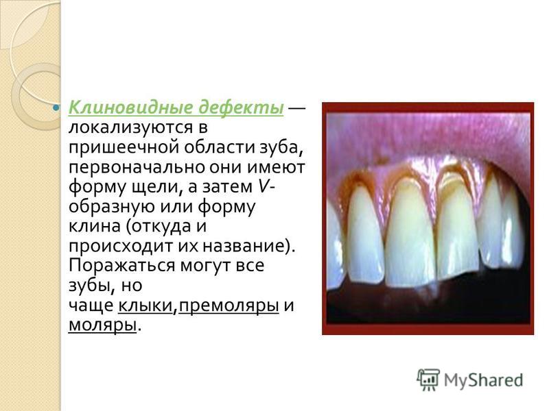 Дефект твердых тканей зуба это Дефект твердых тканей зуба это