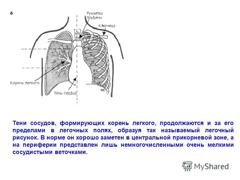 Усилен прикорневой рисунок легких Усилен прикорневой рисунок легких