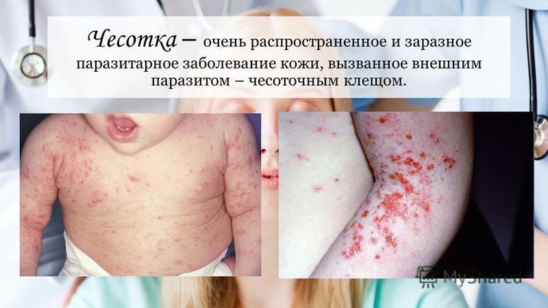Болезнь Чесотка Фото Болезнь Чесотка Фото