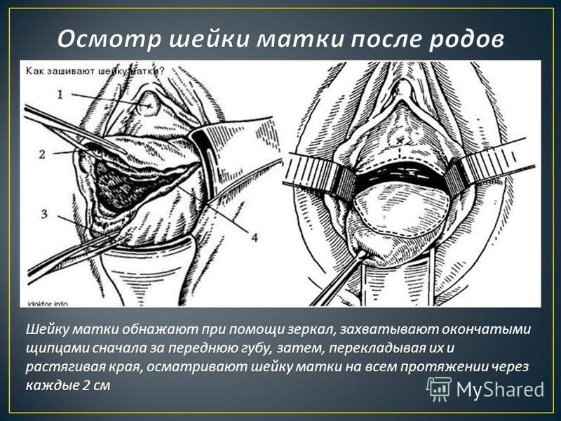 Беременность зашивание матки Беременность зашивание матки