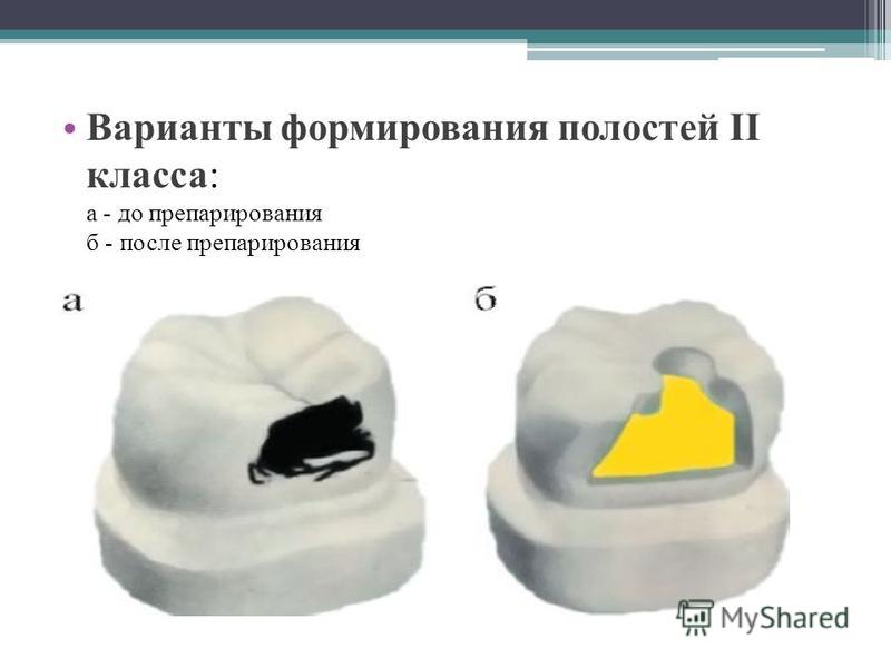 Классификация кариозных полостей по блэку презентация