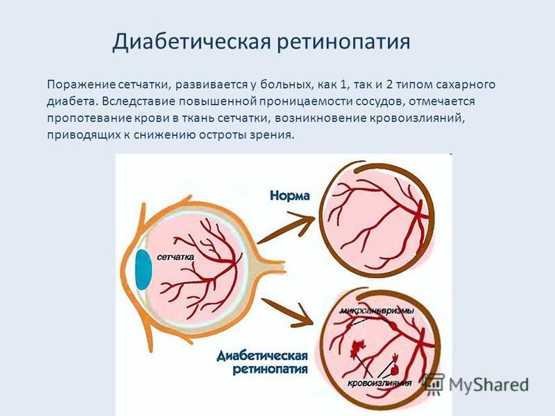 Асд2 и диабет 2 типа