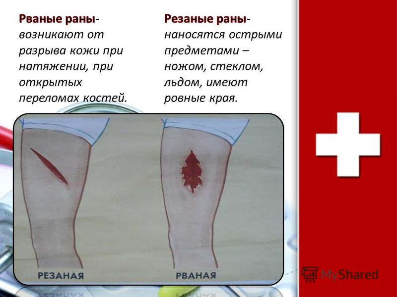 Рваная рана ногтей Рваная рана ногтей