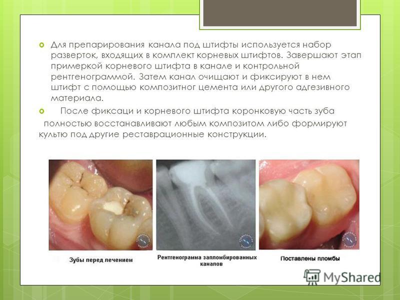 Препарирование корня для штифтовых зубов Препарирование корня для штифтовых зубов