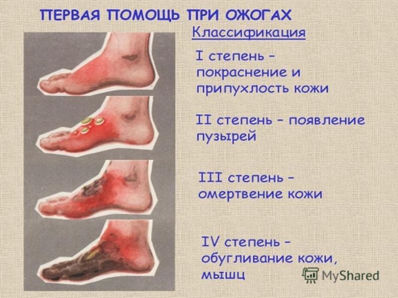 Степени ожогов кожи и их признаки Степени ожогов кожи и их признаки