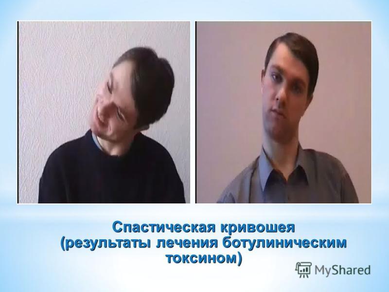 Лечение Спастической Кривошеи В Новосибирске