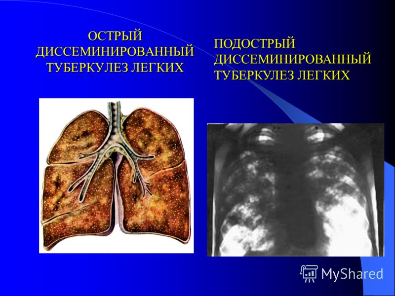 Туберкулез Милиарный фото