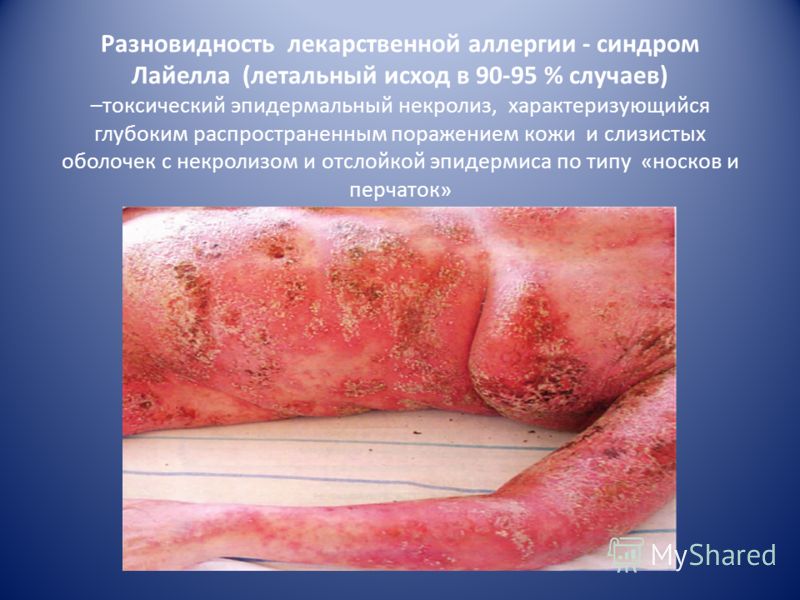 Псориаз у детей причины и фото