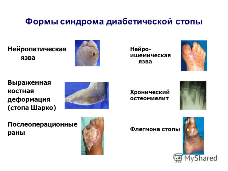 Плоскостопие Самые эффективные методы лечения