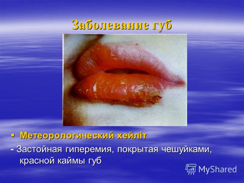 Характеристика сыпи при псориазе