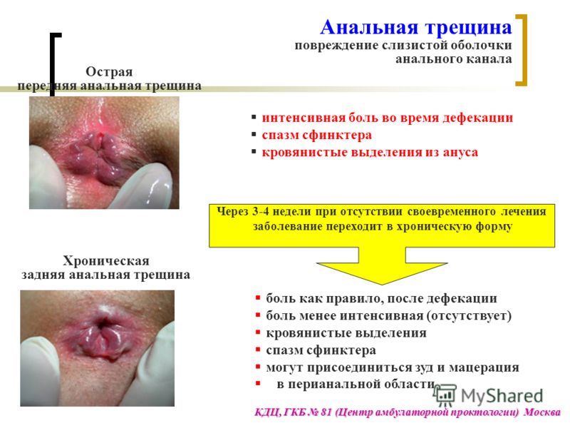 Что можно при беременности если кровит геморрой