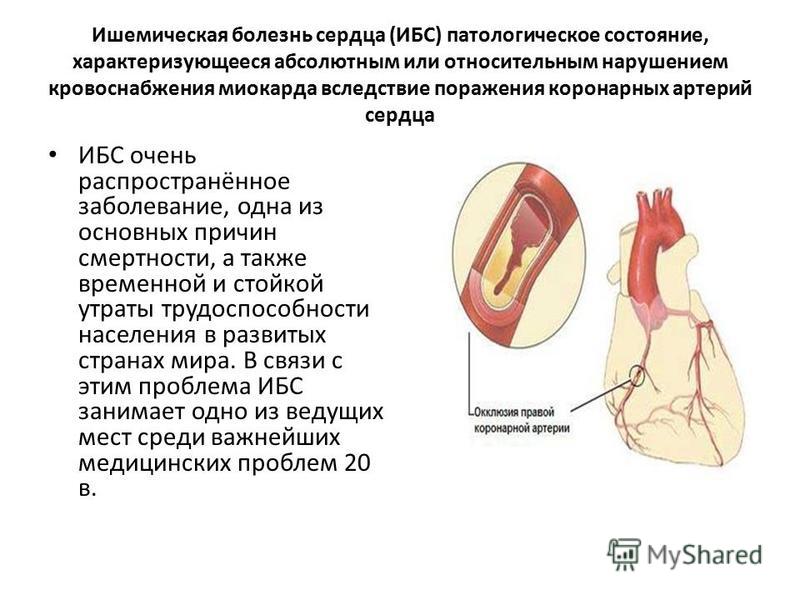 Реферат: Ишемическая болезнь сердца