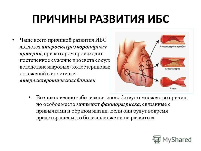 Реферат: Ишемическая болезнь сердца