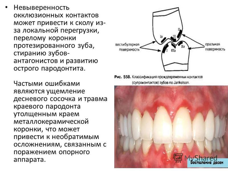 Воспалилась десна над переднем зубе Воспалилась десна над переднем зубе