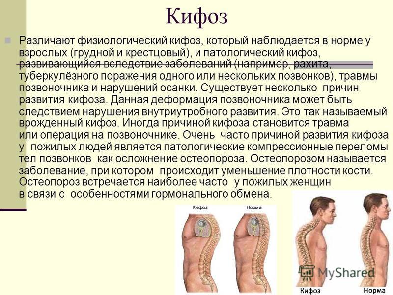 Физиологический кифоз позвоночника Физиологический кифоз позвоночника