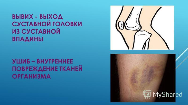 Как лечить ушибы и растяжения в домашних условиях - Vendservice.ru