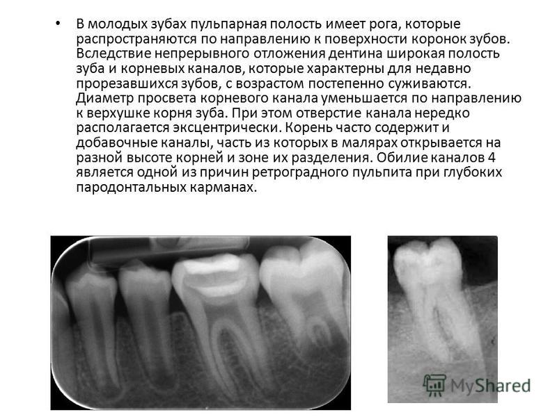 Раскололся один из корней зуба Раскололся один из корней зуба