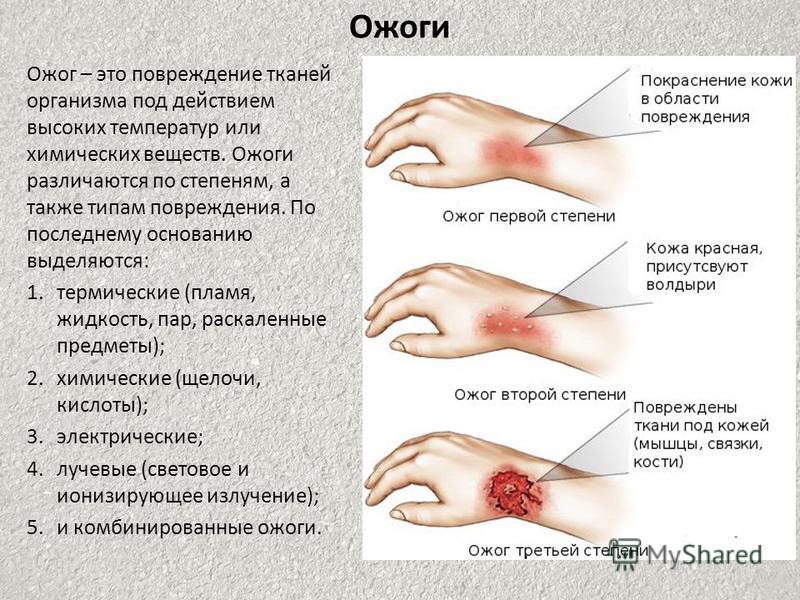 Что делать при ожоге на ноге в домашних условиях Что делать при ожоге на ноге в домашних условиях