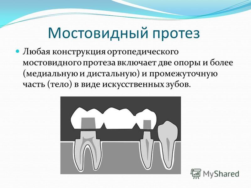 Схема мостовидного протеза