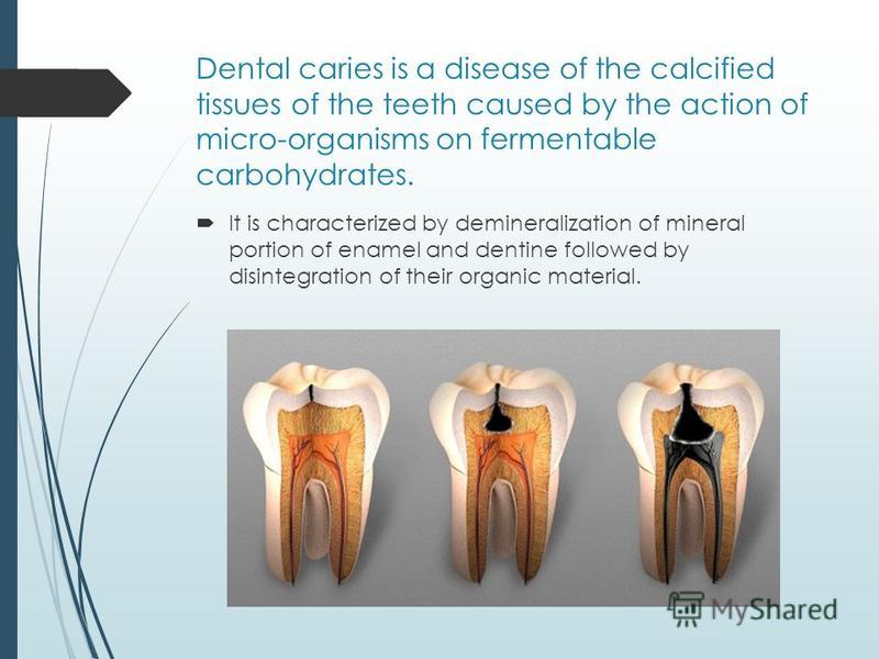 dental caries Background and objective: dental caries in young children is commonly untreated and represents a public health problem dental caries in children is reported to affect their anthropometric outcomes, but the evidence is conflicting. dental caries Background and objective: dental caries in young children is commonly untreated and represents a public health problem dental caries in children is reported to affect their anthropometric outcomes, but the evidence is conflicting.