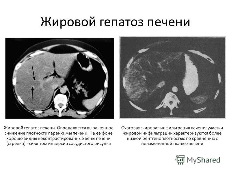 Как лечить жировую дистрофию печени травами Как лечить жировую дистрофию печени травами