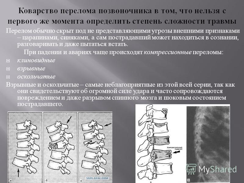 Периоды компрессионный перелома позвоночник Периоды компрессионный перелома позвоночник