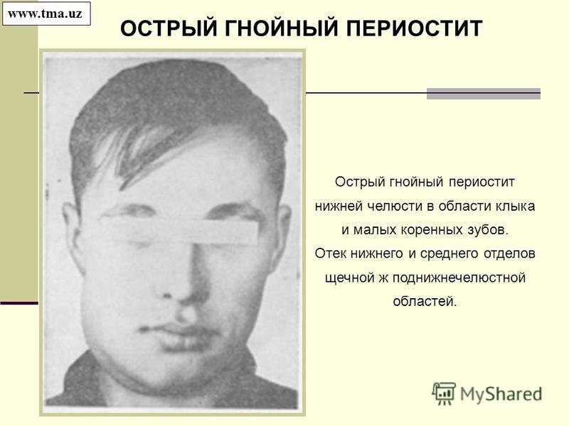 Острый и хронический остеомиелит челюсти, симптомы и лечение на Острый и хронический остеомиелит челюсти, симптомы и лечение на