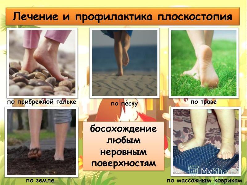 Как лечить поперечное плоскостопие у домашних условиях Как лечить поперечное плоскостопие у домашних условиях