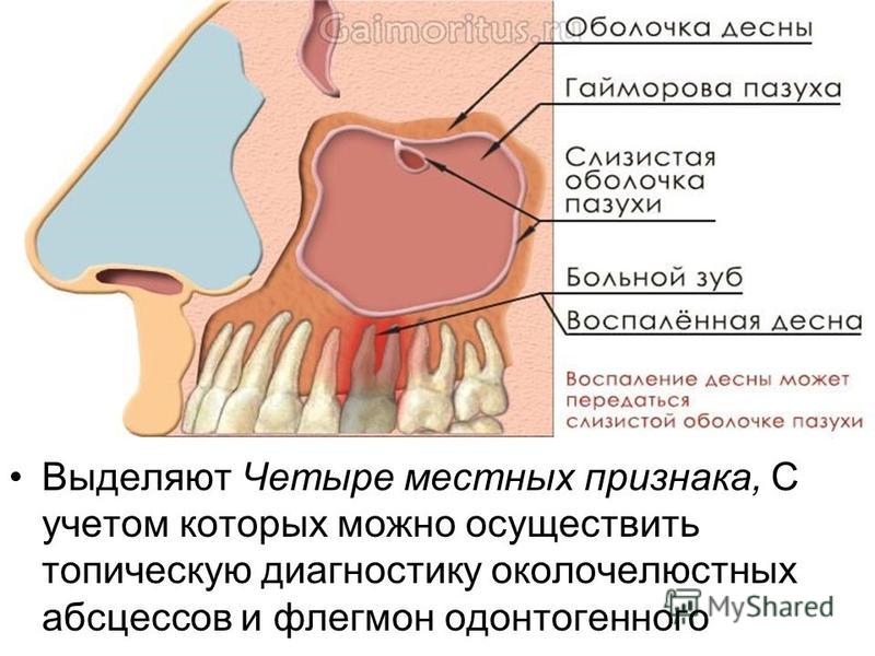 Какие зубы связаны с гайморовой пазухой Какие зубы связаны с гайморовой пазухой