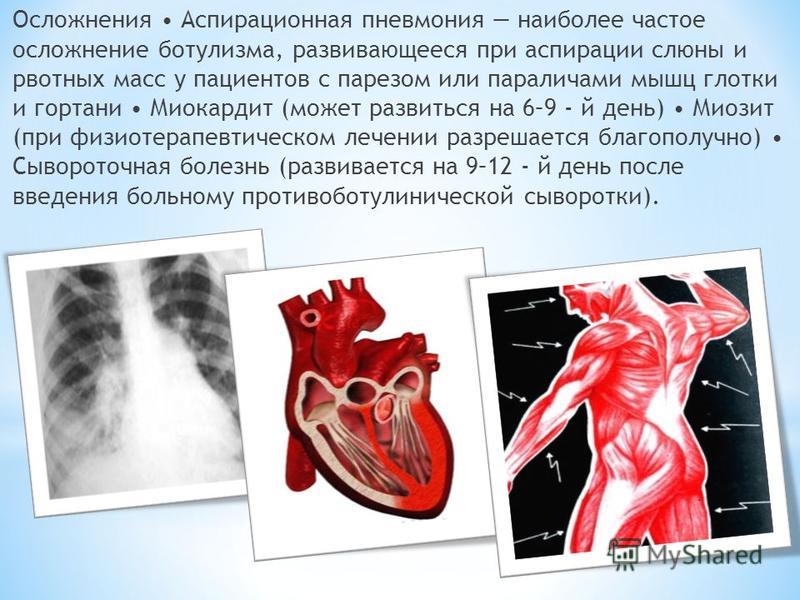 Доклад по теме Ботулизм 