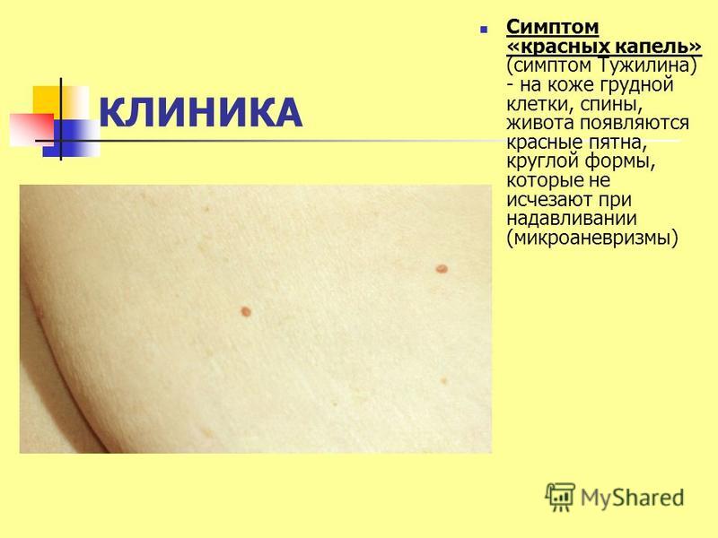 Сыпь на коже при болезни печени Сыпь на коже при болезни печени