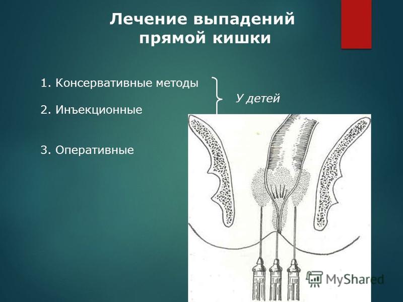 Как выглядит выпавшая кишка человека