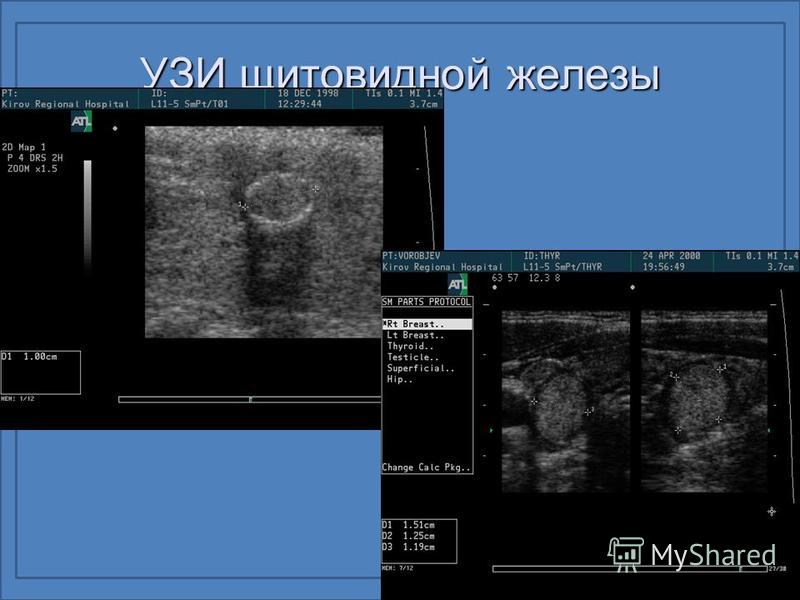 foto Гипоплазия щитовидной железы изображения foto Гипоплазия щитовидной железы изображения